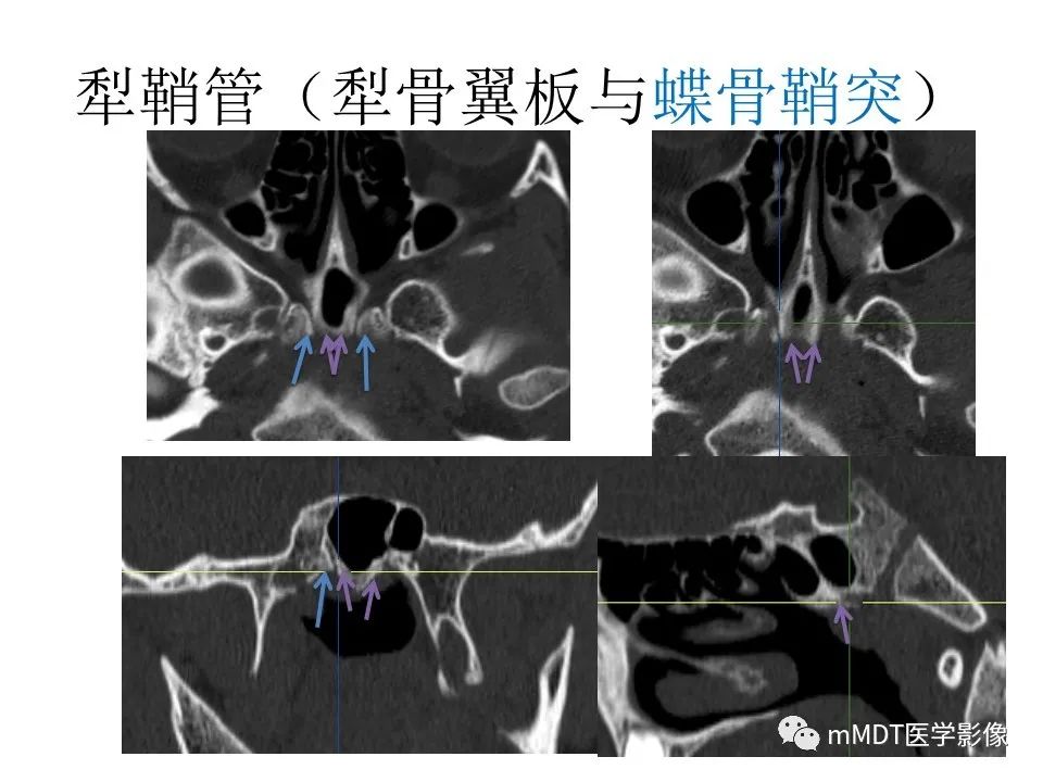 影像PPT - 【PPT】小小孔穴连洞天——翼腭窝的颅底交通-42