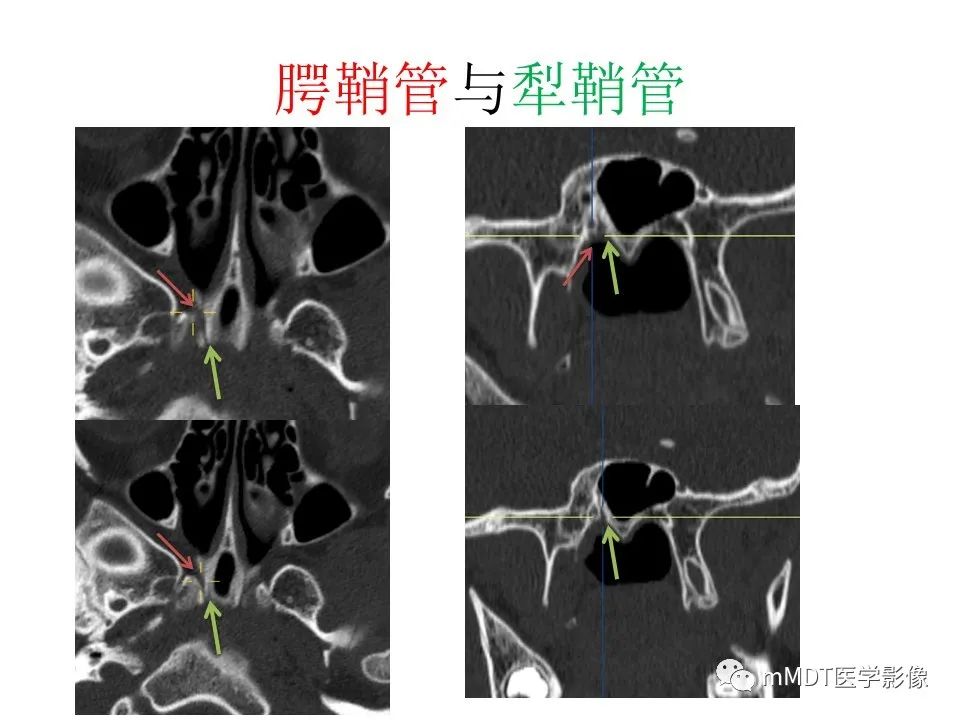 影像PPT - 【PPT】小小孔穴连洞天——翼腭窝的颅底交通-43