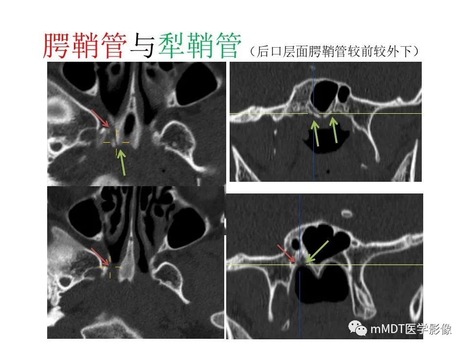 影像PPT - 【PPT】小小孔穴连洞天——翼腭窝的颅底交通-44