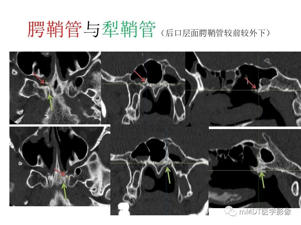 影像PPT - 【PPT】小小孔穴连洞天——翼腭窝的颅底交通-45