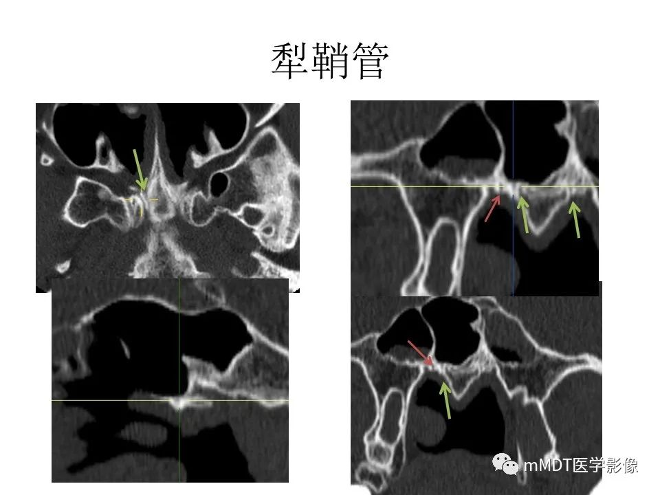 影像PPT - 【PPT】小小孔穴连洞天——翼腭窝的颅底交通-47