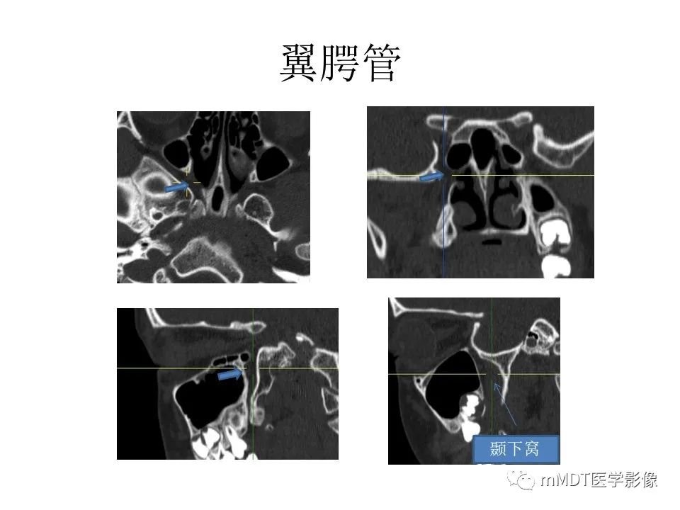 影像PPT - 【PPT】小小孔穴连洞天——翼腭窝的颅底交通-48