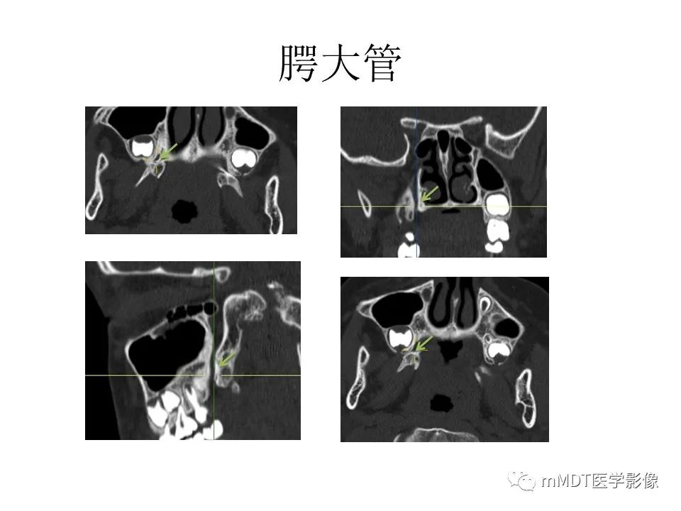 影像PPT - 【PPT】小小孔穴连洞天——翼腭窝的颅底交通-49
