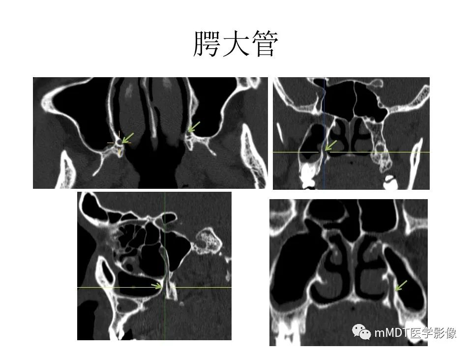 影像PPT - 【PPT】小小孔穴连洞天——翼腭窝的颅底交通-50