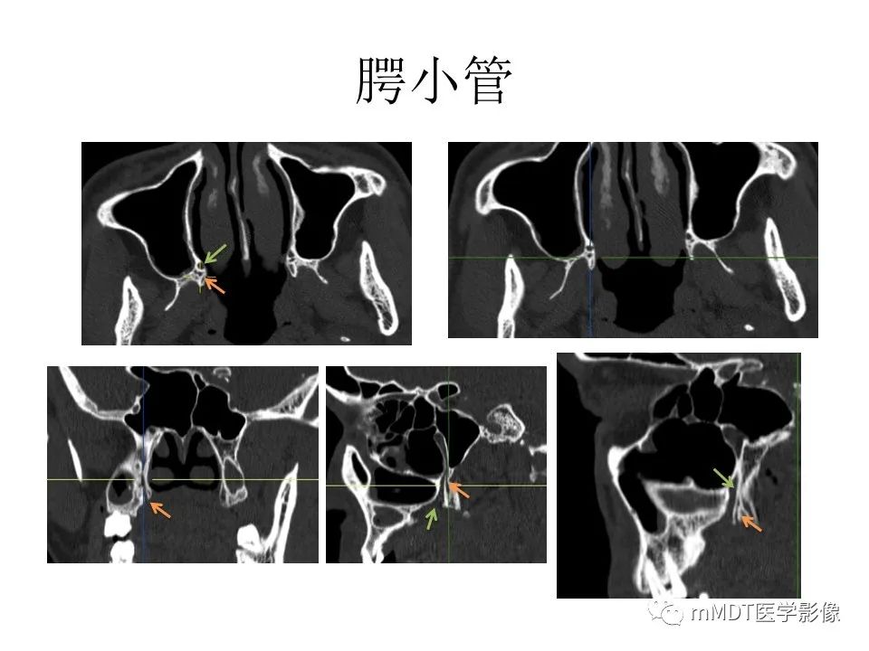影像PPT - 【PPT】小小孔穴连洞天——翼腭窝的颅底交通-51
