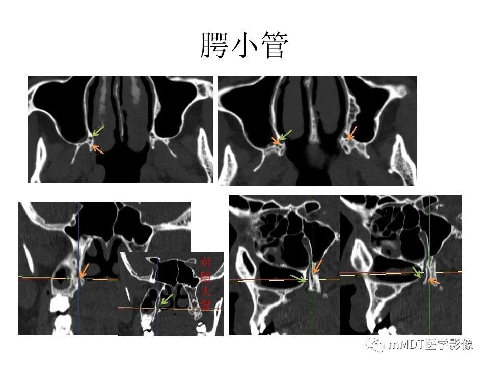 影像PPT - 【PPT】小小孔穴连洞天——翼腭窝的颅底交通-52