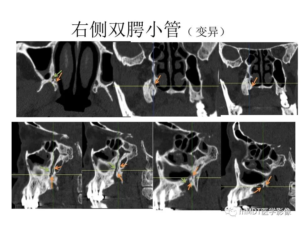 影像PPT - 【PPT】小小孔穴连洞天——翼腭窝的颅底交通-53