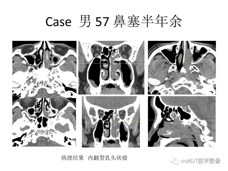影像PPT - 【PPT】小小孔穴连洞天——翼腭窝的颅底交通-55