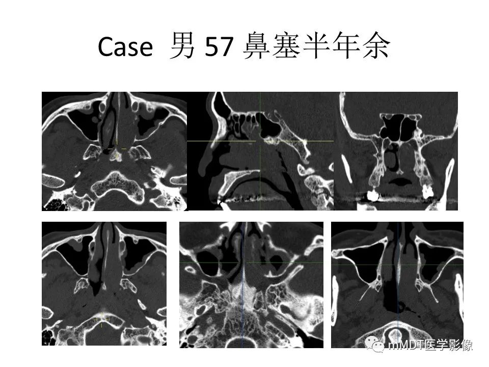 影像PPT - 【PPT】小小孔穴连洞天——翼腭窝的颅底交通-56