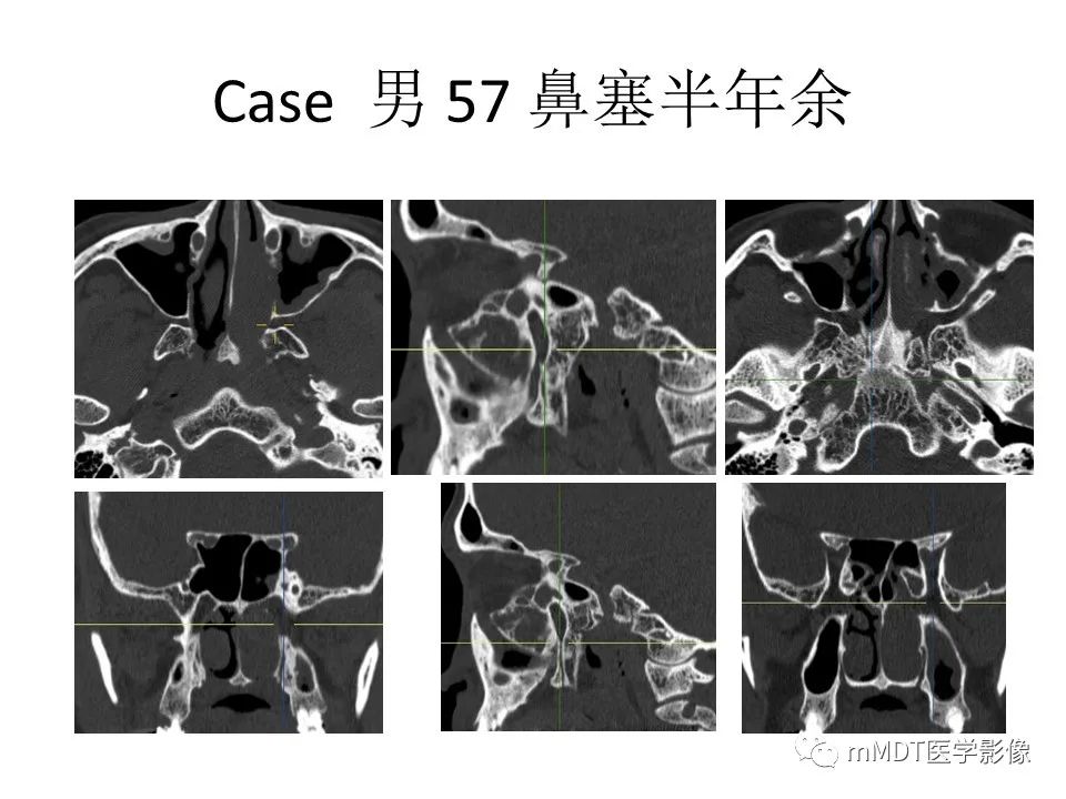 影像PPT - 【PPT】小小孔穴连洞天——翼腭窝的颅底交通-57