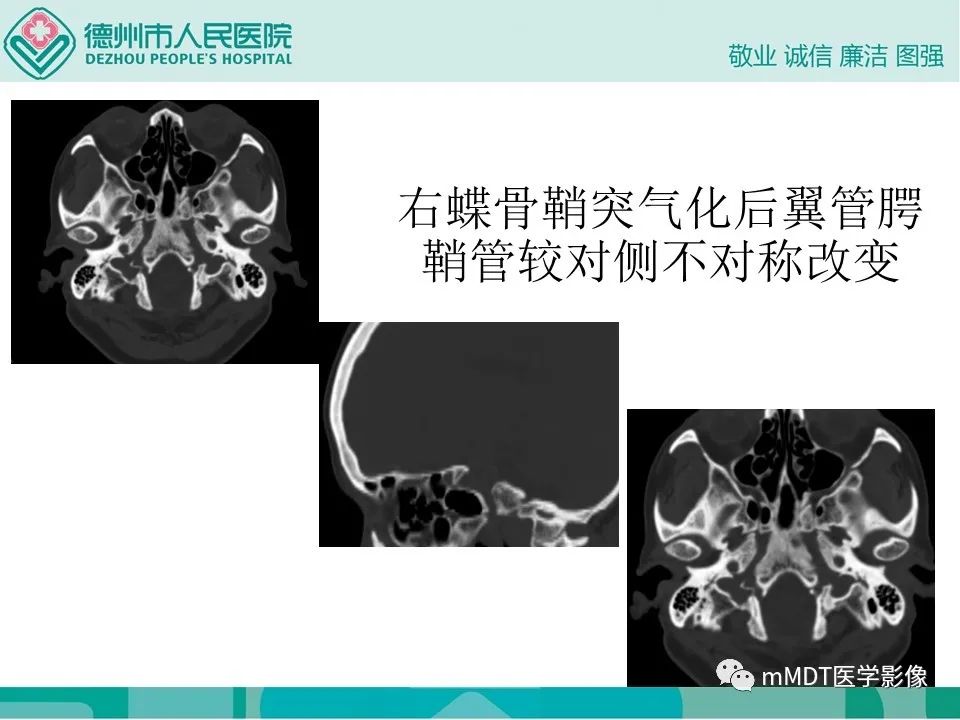 影像PPT - 【PPT】小小孔穴连洞天——翼腭窝的颅底交通-58