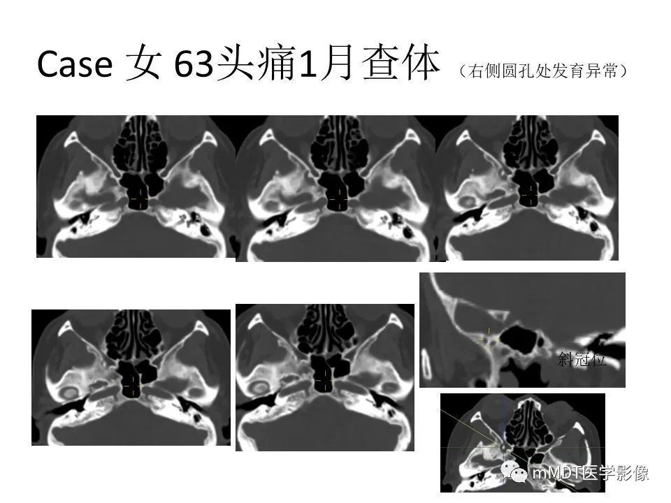 影像PPT - 【PPT】小小孔穴连洞天——翼腭窝的颅底交通-59