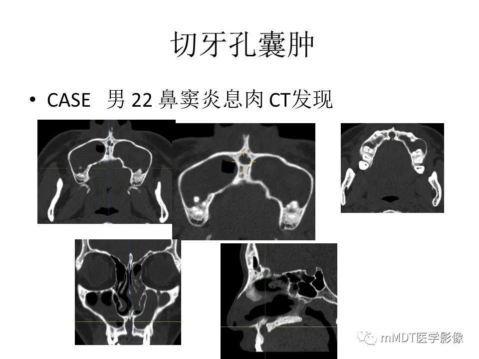 影像PPT - 【PPT】小小孔穴连洞天——翼腭窝的颅底交通-60