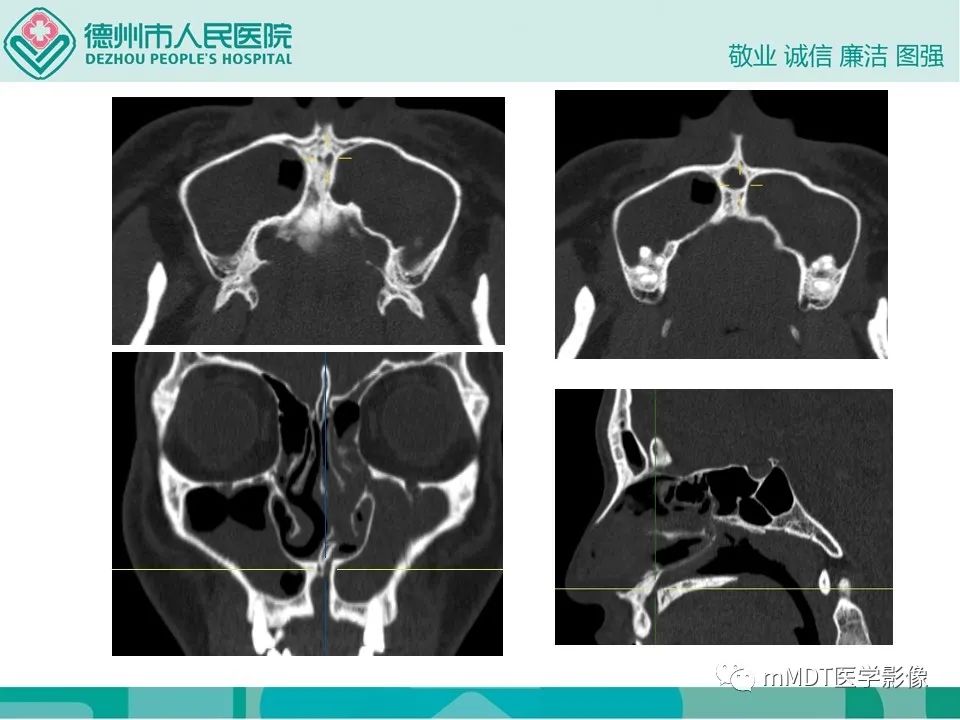 影像PPT - 【PPT】小小孔穴连洞天——翼腭窝的颅底交通-61