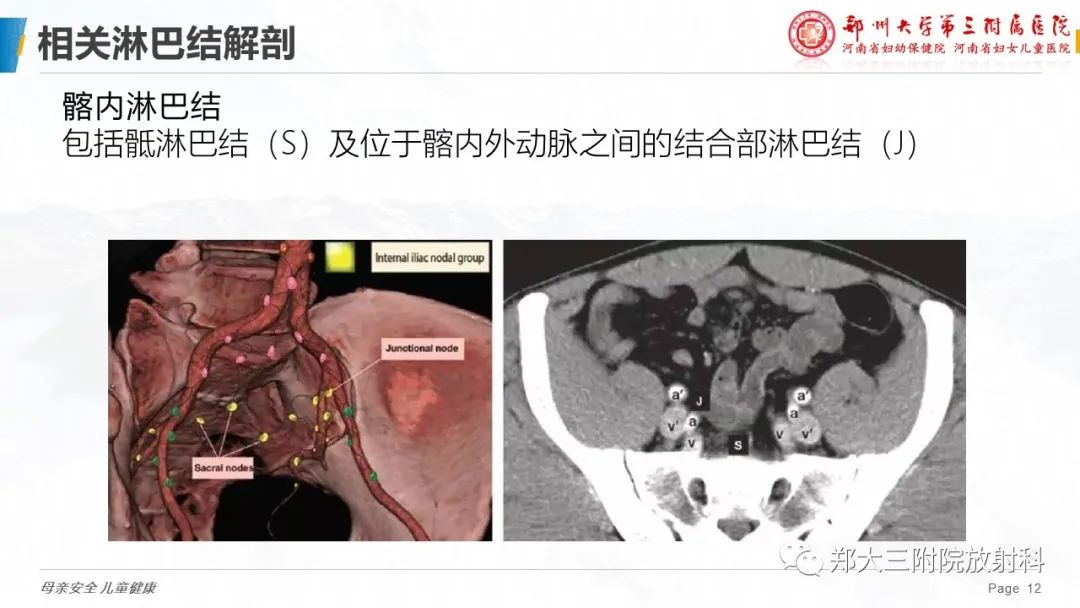 影像PPT - 【PPT】妇科恶性肿瘤淋巴结转移特点-11