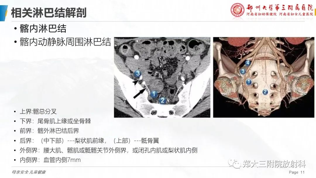 影像PPT - 【PPT】妇科恶性肿瘤淋巴结转移特点-10