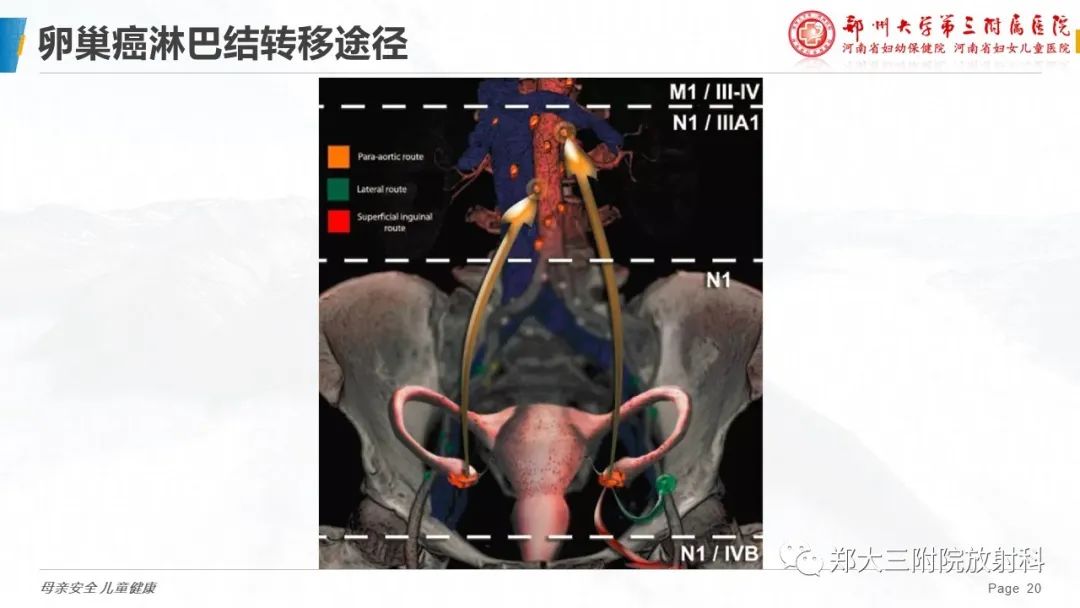 影像PPT - 【PPT】妇科恶性肿瘤淋巴结转移特点-18