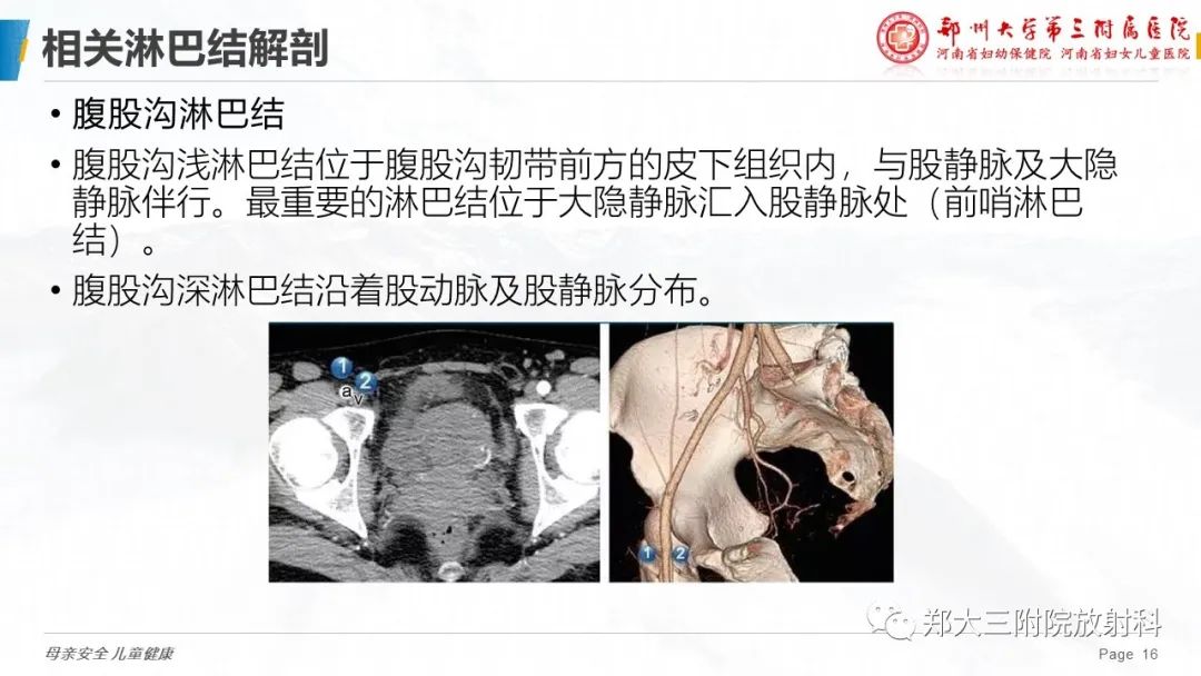 影像PPT - 【PPT】妇科恶性肿瘤淋巴结转移特点-14