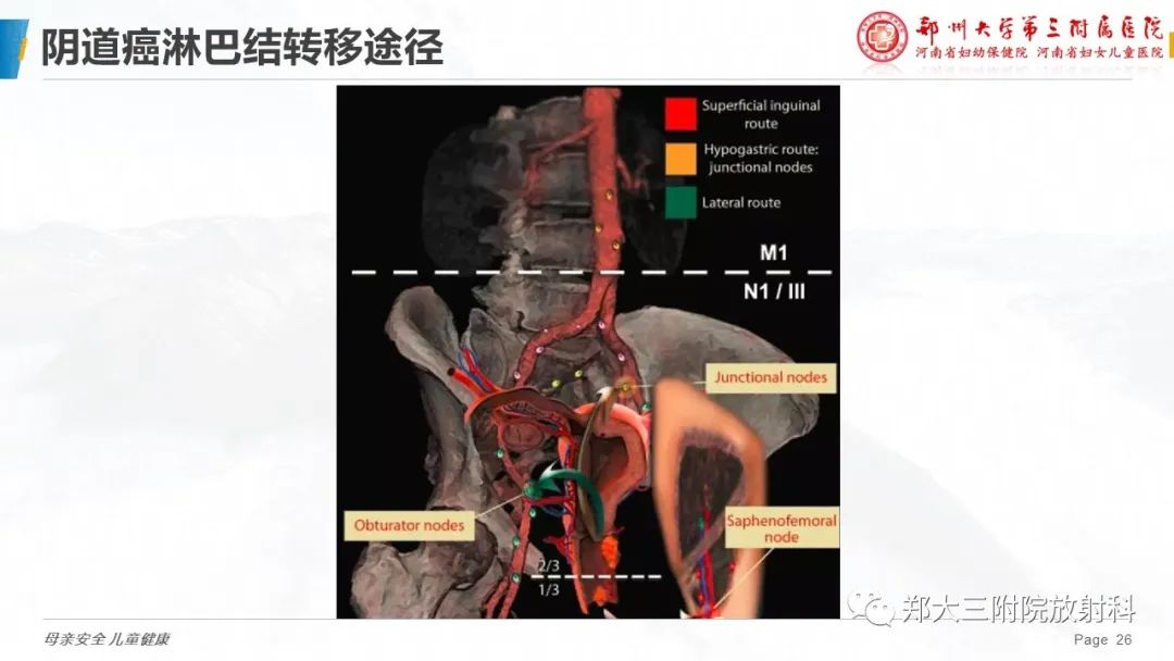 影像PPT - 【PPT】妇科恶性肿瘤淋巴结转移特点-23