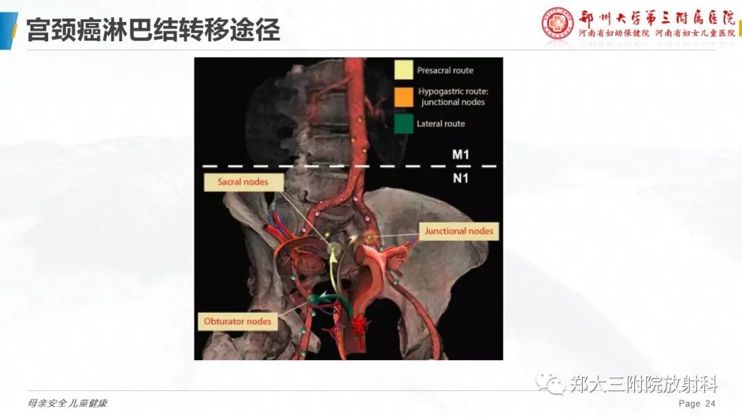 影像PPT - 【PPT】妇科恶性肿瘤淋巴结转移特点-21