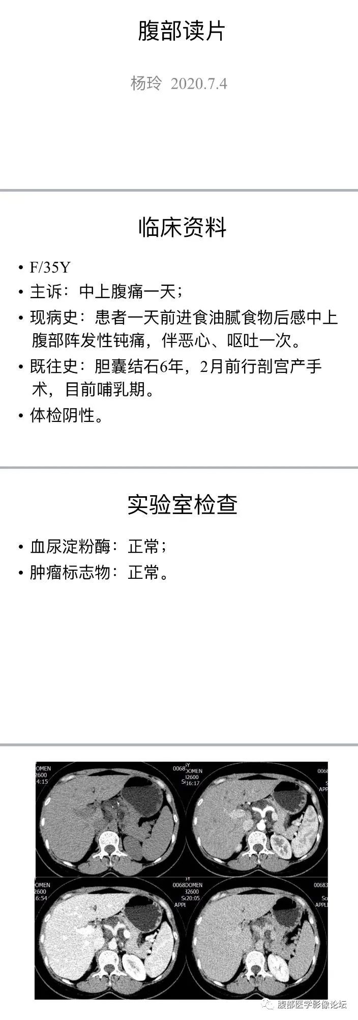 影像PPT - 【病例】腹膜后淋巴管瘤-1 影像PPT - 【病例】腹膜后淋巴管瘤-1