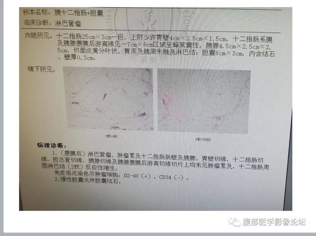 影像PPT - 【病例】腹膜后淋巴管瘤-4 影像PPT - 【病例】腹膜后淋巴管瘤-4