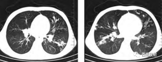 影像PPT - 肺囊性纤维化-3 影像PPT - 肺囊性纤维化-3