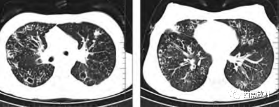 影像PPT - 肺囊性纤维化-5 影像PPT - 肺囊性纤维化-5