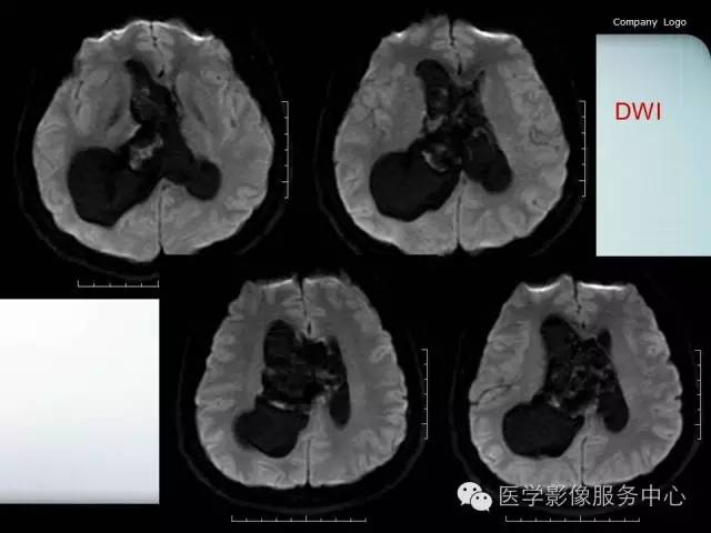 影像PPT - 【病例】侧脑室中枢神经细胞瘤伴血管瘤样改变1例MR-4 影像PPT - 【病例】侧脑室中枢神经细胞瘤伴血管瘤样改变1例MR-4