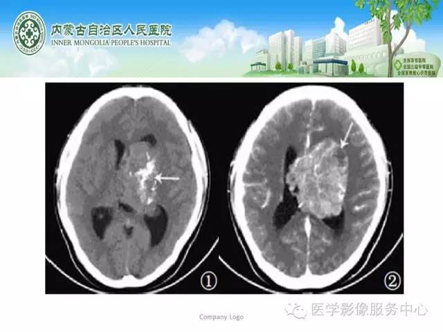 影像PPT - 【病例】侧脑室中枢神经细胞瘤伴血管瘤样改变1例MR-21 影像PPT - 【病例】侧脑室中枢神经细胞瘤伴血管瘤样改变1例MR-21
