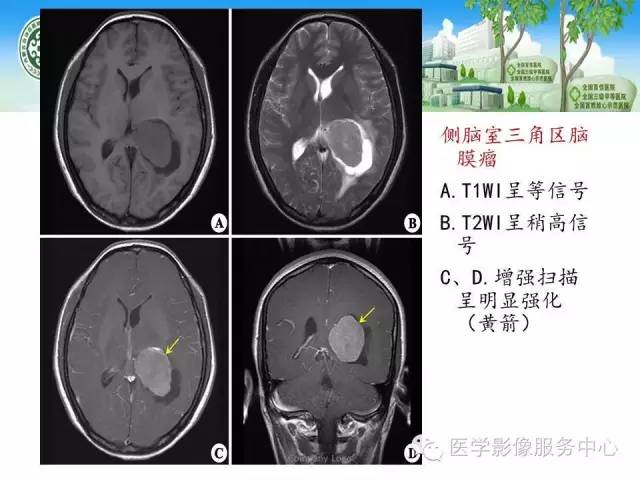 影像PPT - 【病例】侧脑室中枢神经细胞瘤伴血管瘤样改变1例MR-29 影像PPT - 【病例】侧脑室中枢神经细胞瘤伴血管瘤样改变1例MR-29