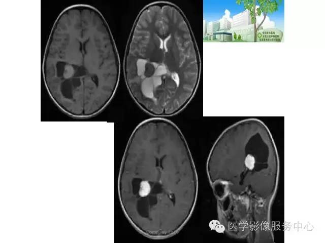 影像PPT - 【病例】侧脑室中枢神经细胞瘤伴血管瘤样改变1例MR-37 影像PPT - 【病例】侧脑室中枢神经细胞瘤伴血管瘤样改变1例MR-37
