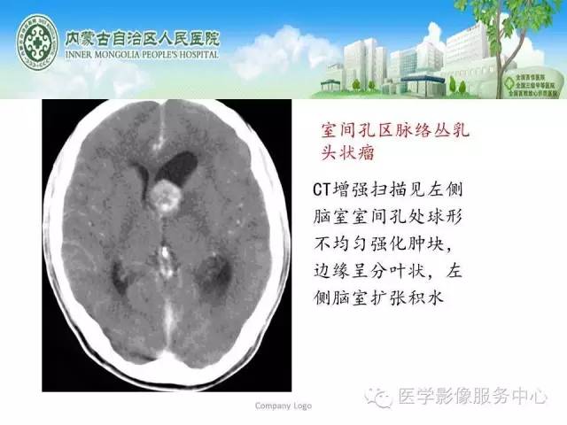 影像PPT - 【病例】侧脑室中枢神经细胞瘤伴血管瘤样改变1例MR-35 影像PPT - 【病例】侧脑室中枢神经细胞瘤伴血管瘤样改变1例MR-35