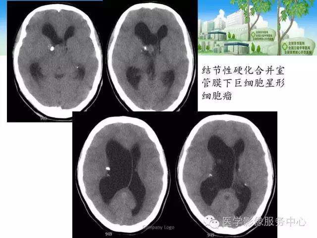 影像PPT - 【病例】侧脑室中枢神经细胞瘤伴血管瘤样改变1例MR-40 影像PPT - 【病例】侧脑室中枢神经细胞瘤伴血管瘤样改变1例MR-40