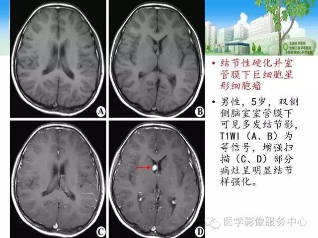影像PPT - 【病例】侧脑室中枢神经细胞瘤伴血管瘤样改变1例MR-42 影像PPT - 【病例】侧脑室中枢神经细胞瘤伴血管瘤样改变1例MR-42