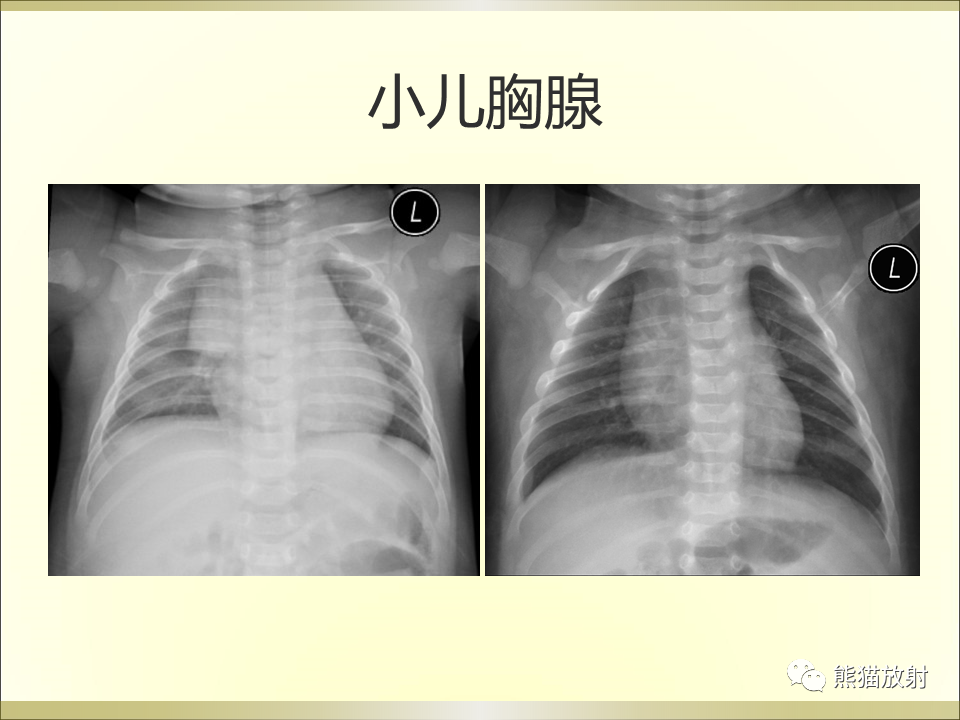 影像PPT - 【PPT】小儿肺炎的影像学诊断-7