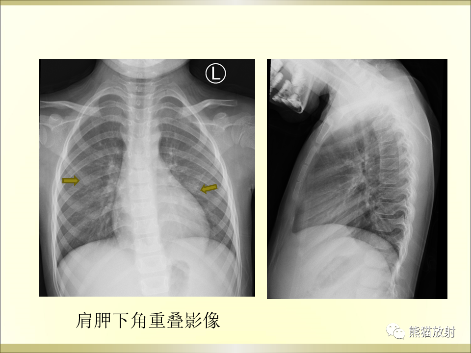影像PPT - 【PPT】小儿肺炎的影像学诊断-8