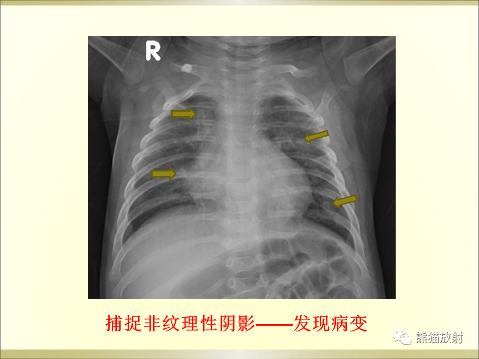 影像PPT - 【PPT】小儿肺炎的影像学诊断-10