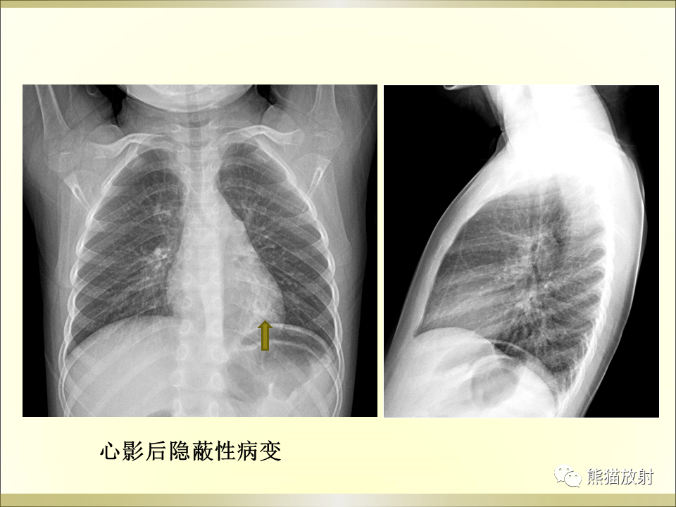 影像PPT - 【PPT】小儿肺炎的影像学诊断-11