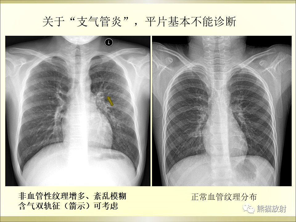 影像PPT - 【PPT】小儿肺炎的影像学诊断-9