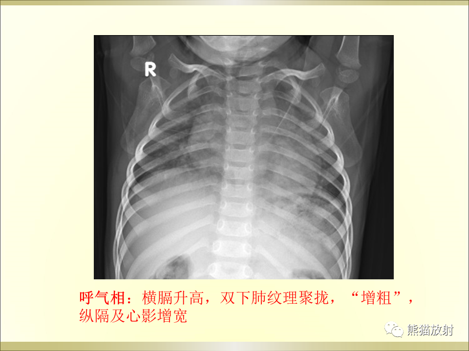 影像PPT - 【PPT】小儿肺炎的影像学诊断-14