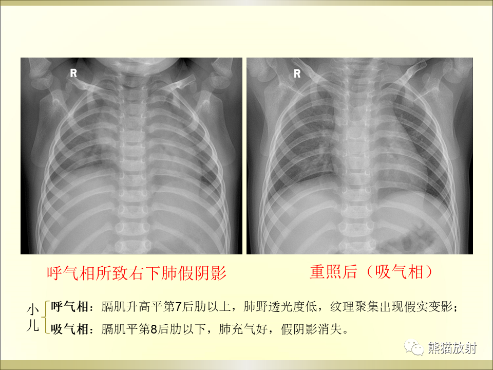 影像PPT - 【PPT】小儿肺炎的影像学诊断-15