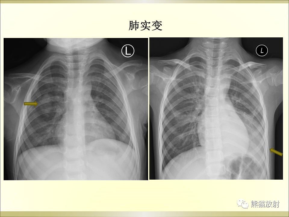 影像PPT - 【PPT】小儿肺炎的影像学诊断-18