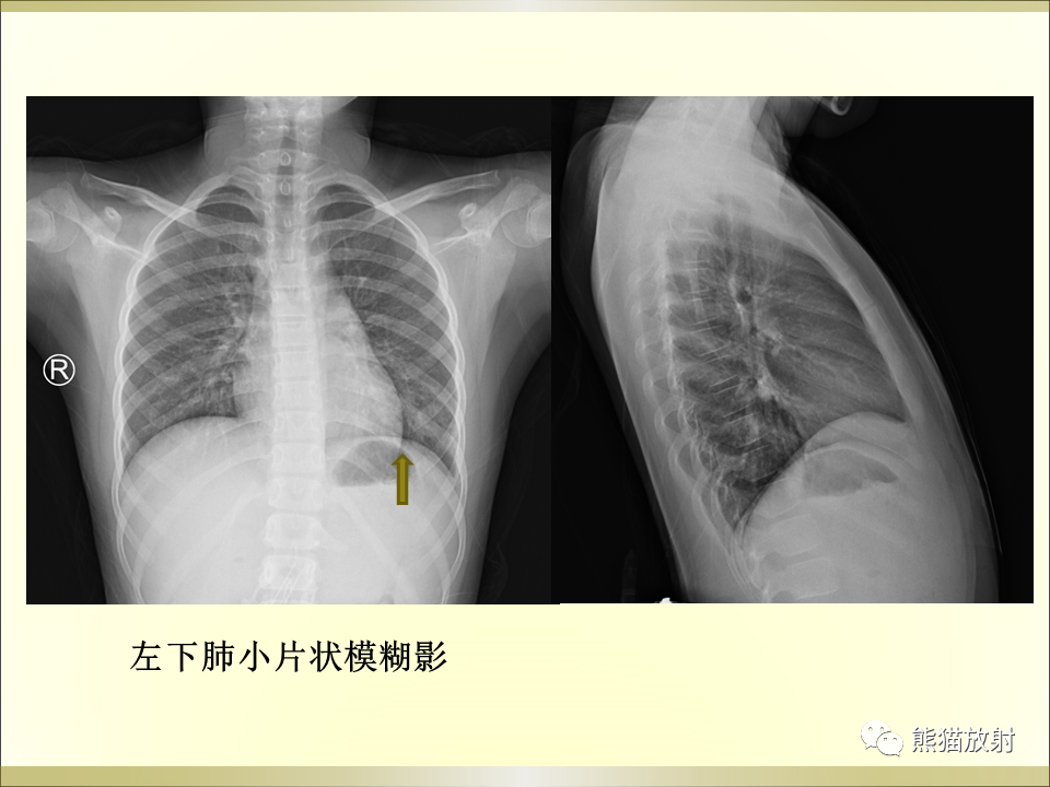 影像PPT - 【PPT】小儿肺炎的影像学诊断-19
