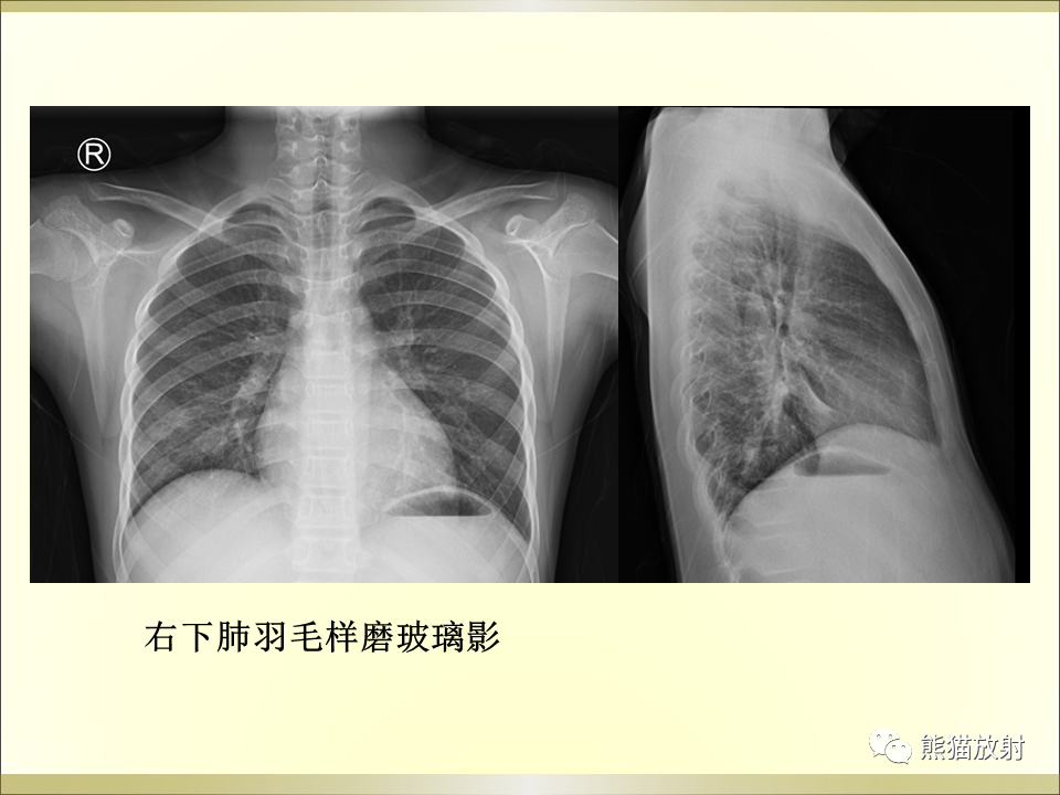 影像PPT - 【PPT】小儿肺炎的影像学诊断-20
