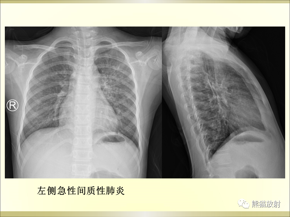 影像PPT - 【PPT】小儿肺炎的影像学诊断-22