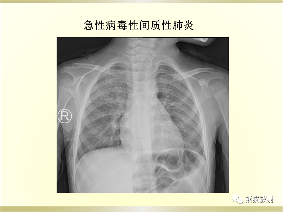 影像PPT - 【PPT】小儿肺炎的影像学诊断-21