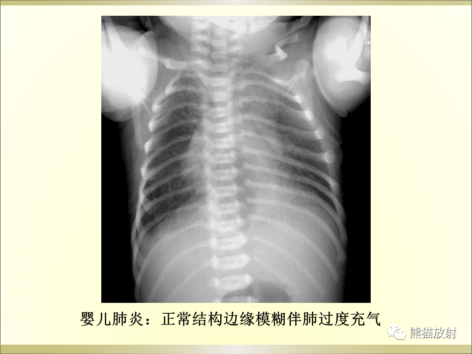 影像PPT - 【PPT】小儿肺炎的影像学诊断-23