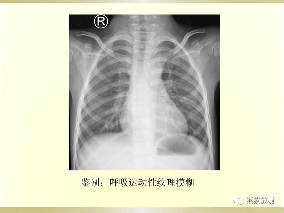 影像PPT - 【PPT】小儿肺炎的影像学诊断-24