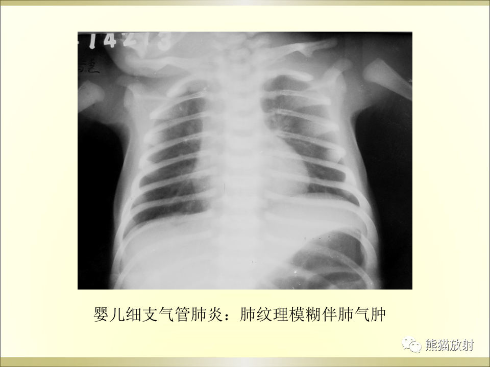 影像PPT - 【PPT】小儿肺炎的影像学诊断-26